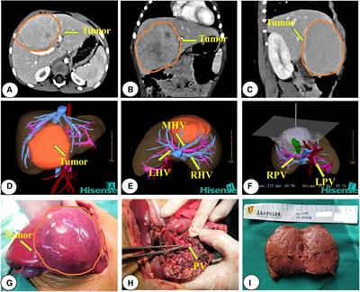 Surgical resection of pediatric PRETEXT III and IV hepatoblastoma: A retrospective study investigating the need for preoperative chemotherapy